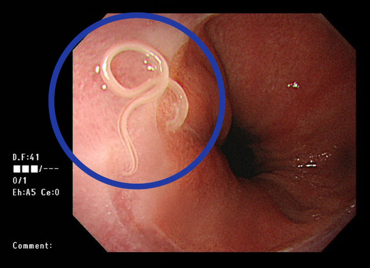 胃の中にいるアニサキス