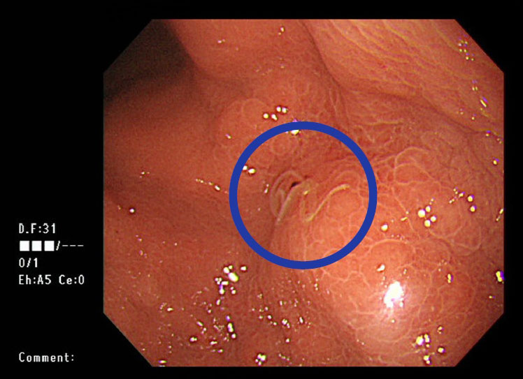 胃の中にいるアニサキス